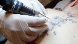 Laser Q Switched per rimozione Tatuaggi